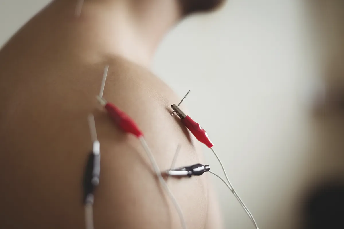 Electroestimulación en rehabilitación neurológica